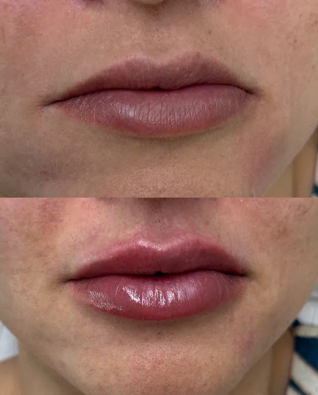 Antes e depois de preenchimento labial com volume na medida certa