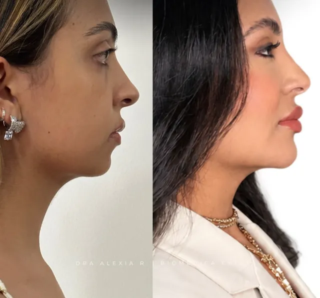 Antes e depois de perfil da harmonização da própria Dra. Alexia