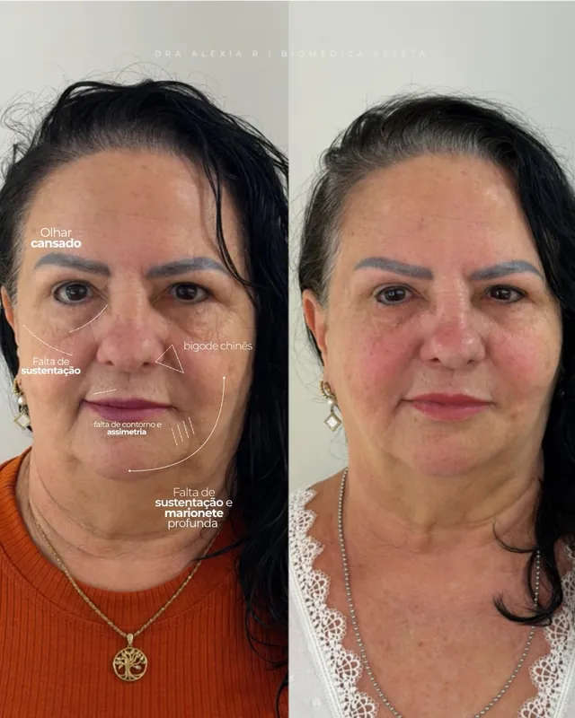 Antes e depois de rejuvenescimento facial, com mais sustentação e contorno