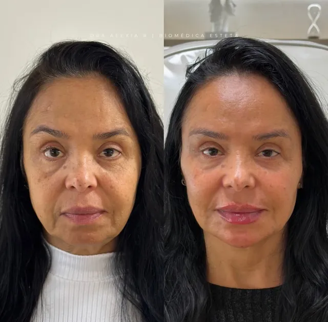 Antes e depois do protocolo Sculpt Face, rosto mais descansado e harmônico