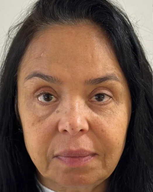 Antes do Sculpt Face, com a análise das queixas da paciente