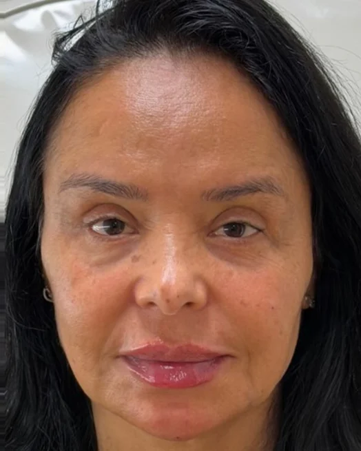 Depois do Sculpt Face: rosto com mais sustentação, contorno definido e olheira suavizada